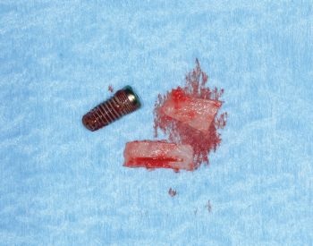 When Implants Go Rogue