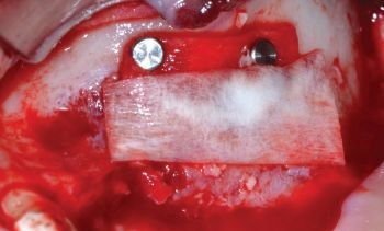 When Implants Go Rogue