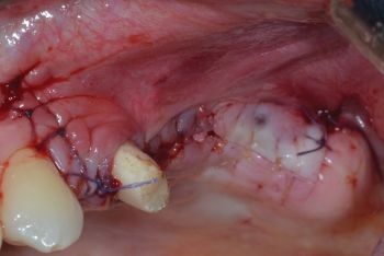 When Implants Go Rogue