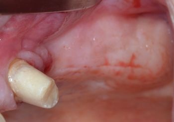 When Implants Go Rogue