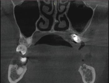 When Implants Go Rogue