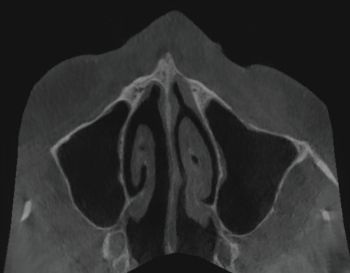 When Implants Go Rogue