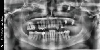 When Implants Go Rogue