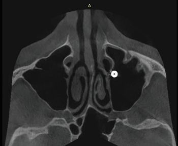 When Implants Go Rogue