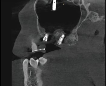 When Implants Go Rogue