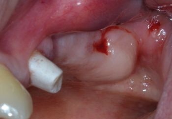 When Implants Go Rogue