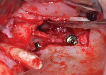 When Implants Go Rogue