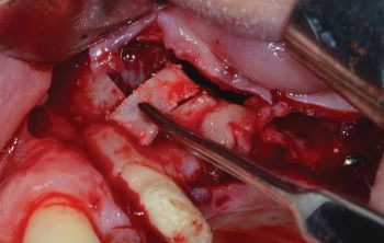 When Implants Go Rogue