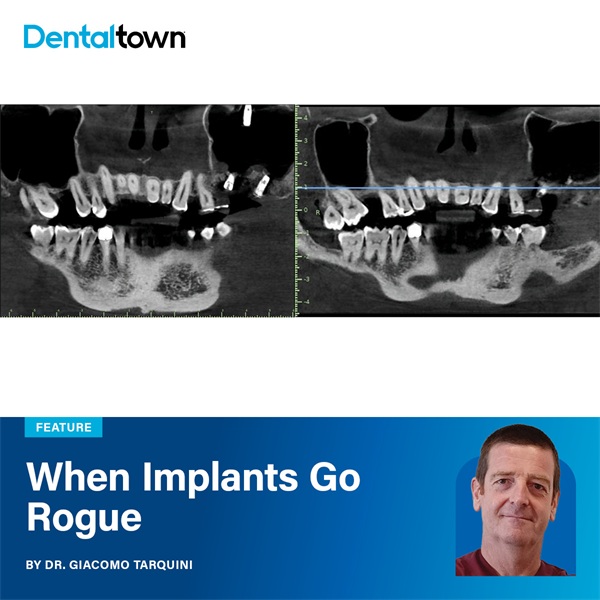 When Implants Go Rogue