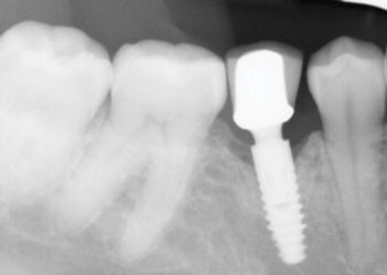 A Laser Approach to Peri-Implantitis Management