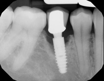 A Laser Approach to Peri-Implantitis Management