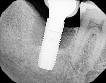 A Laser Approach to Peri-Implantitis Management