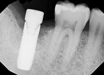 A Laser Approach to Peri-Implantitis Management