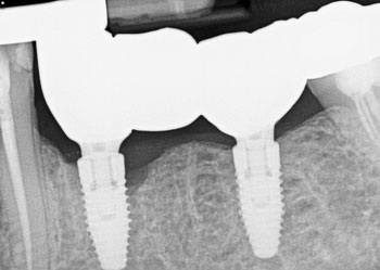 A Laser Approach to Peri-Implantitis Management