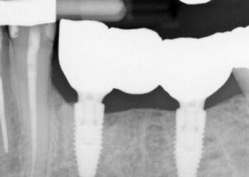 A Laser Approach to Peri-Implantitis Management