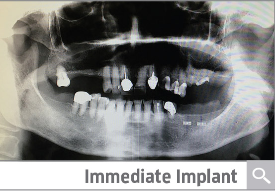 Case Presentation: Immediate Implant
