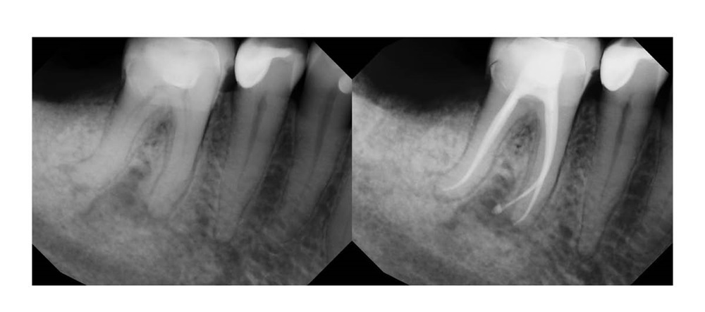 Clinical Case Spotlight: Efficient and Predictable Endodontics