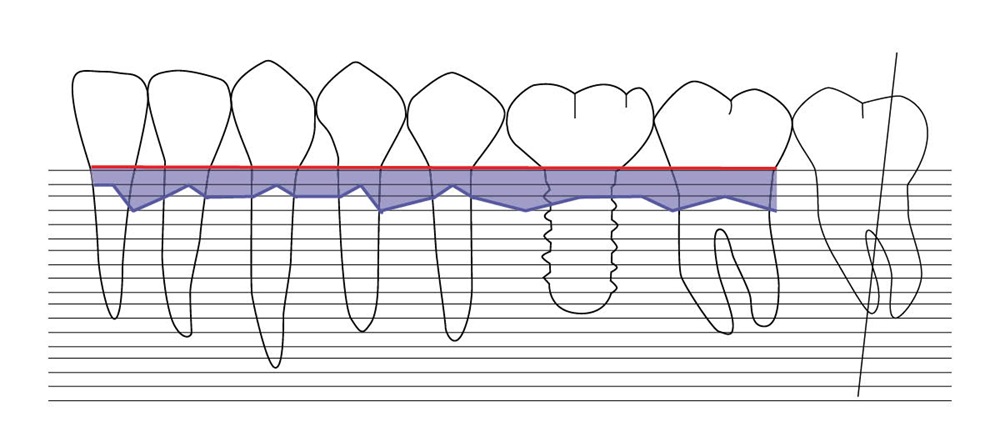 4 Things to Know About Peri-Implantitis