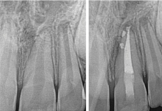 Case Profile: Simplifying Root Canal Preparation
