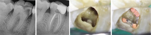 Case Profile: Simplifying Root Canal Preparation