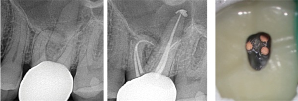 Case Profile: Simplifying Root Canal Preparation