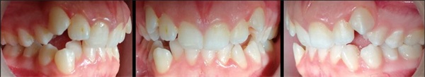 Case Profile: Fastbraces