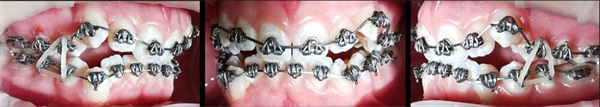 Case Profile: Fastbraces
