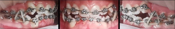 Case Profile: Fastbraces