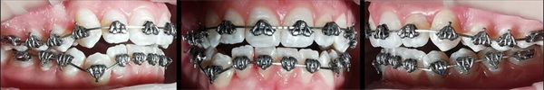 Case Profile: Fastbraces
