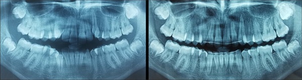 Case Profile: Fastbraces