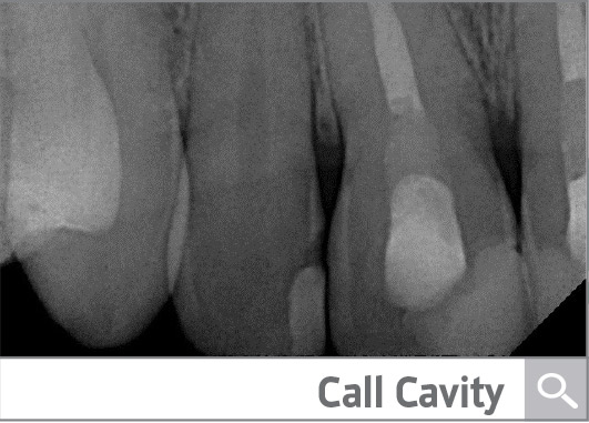 Case Presentation: Immediate Implant