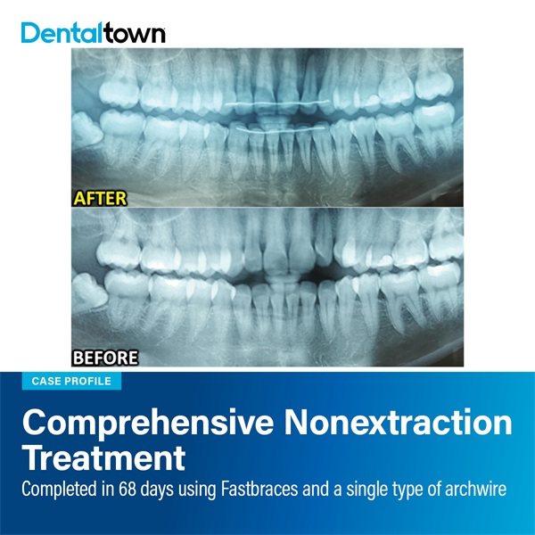 Case Profile: Fastbraces