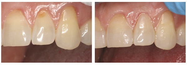 Fewer Steps, Fewer Compromises