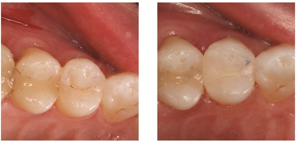 Fewer Steps, Fewer Compromises