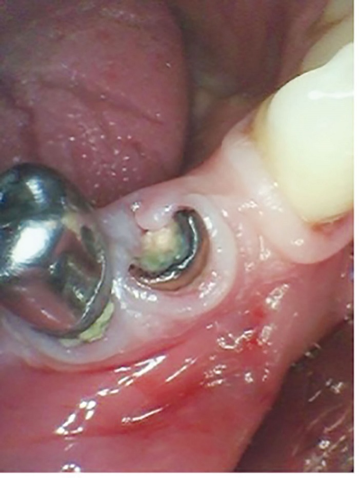 Dental Implant Placement