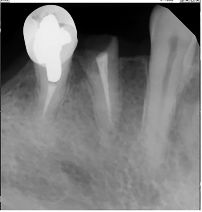 Dental Implant Placement