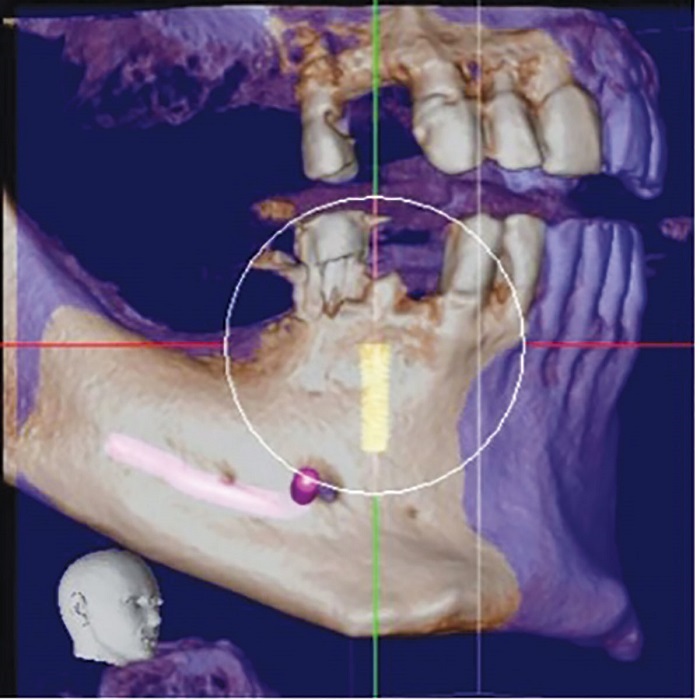 Dental Implant Placement