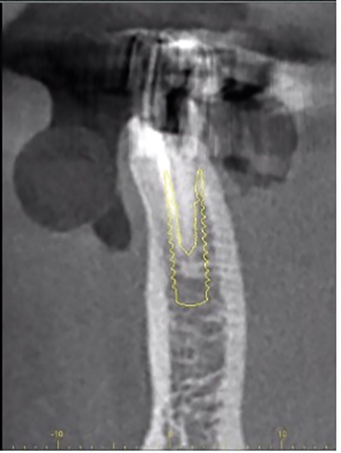 Dental Implant Placement