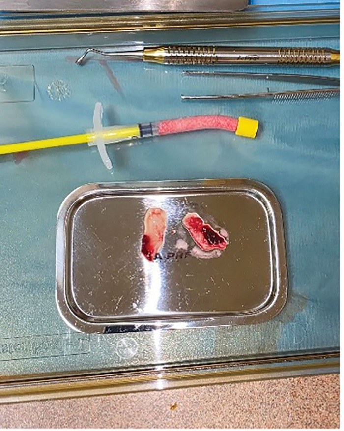 Dental Implant Placement