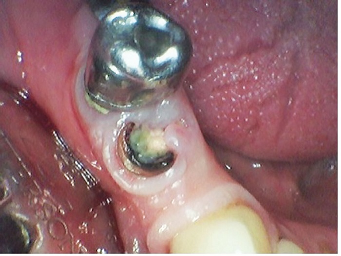 Dental Implant Placement