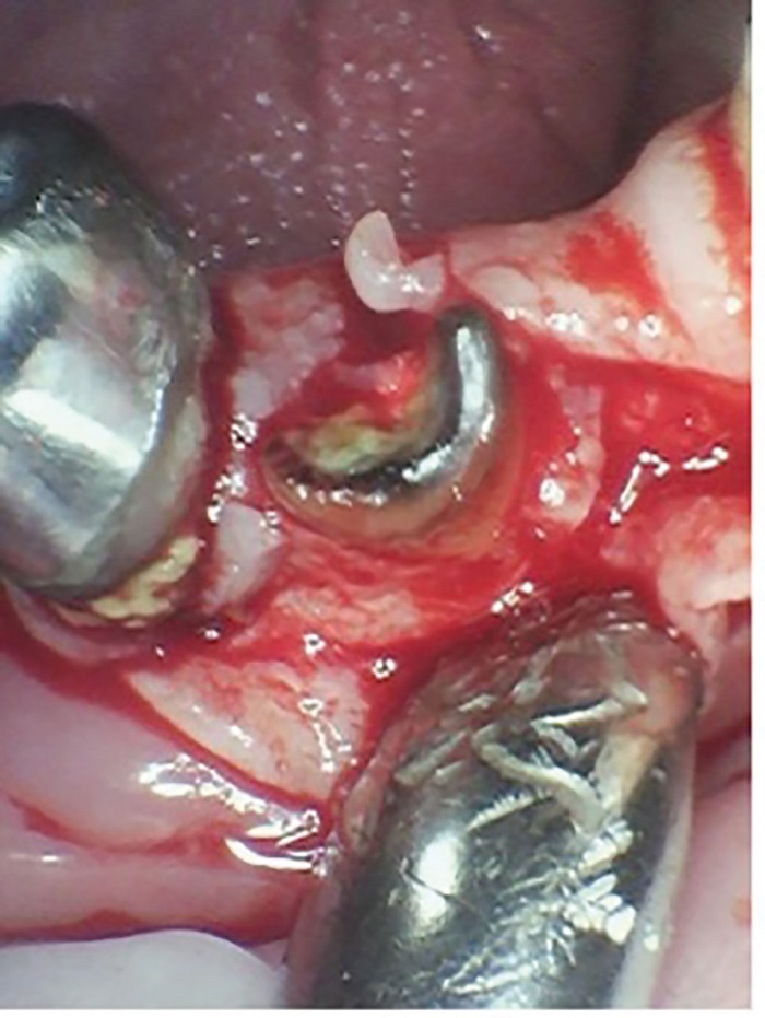 Dental Implant Placement