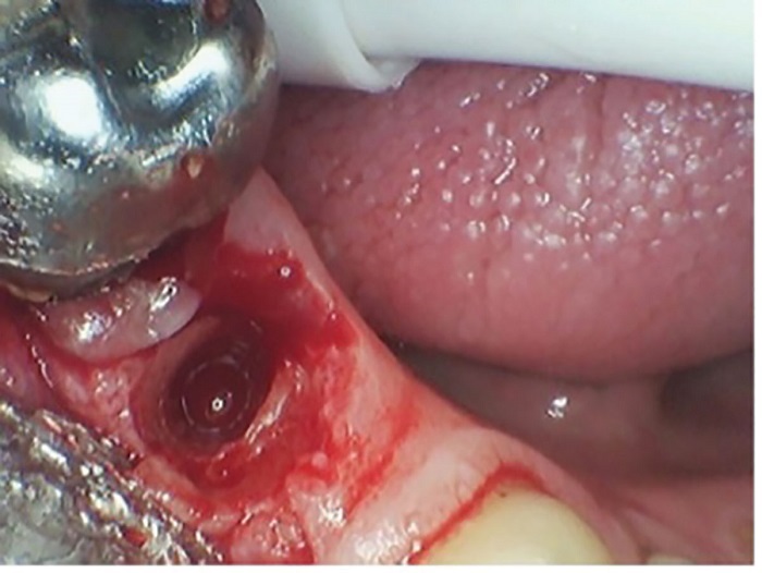 Dental Implant Placement