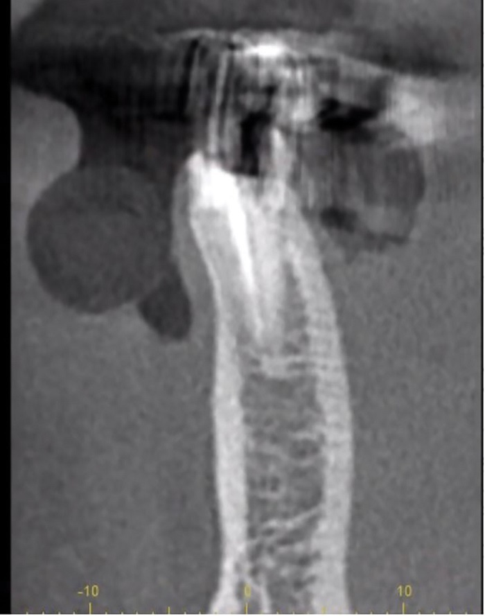 Dental Implant Placement