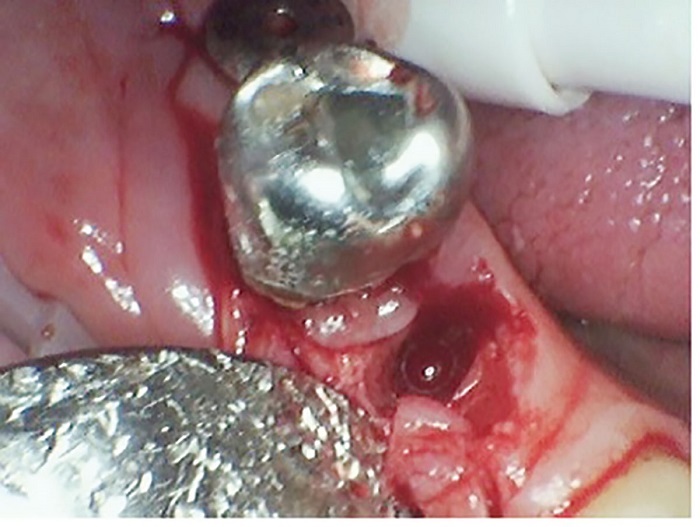 Dental Implant Placement