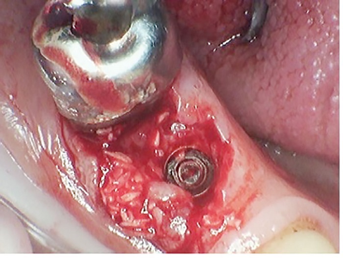 Dental Implant Placement