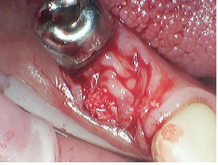 Dental Implant Placement