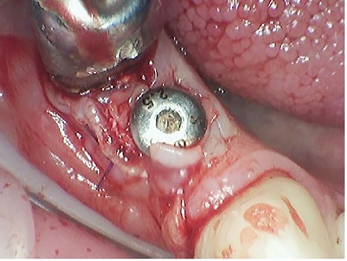 Dental Implant Placement