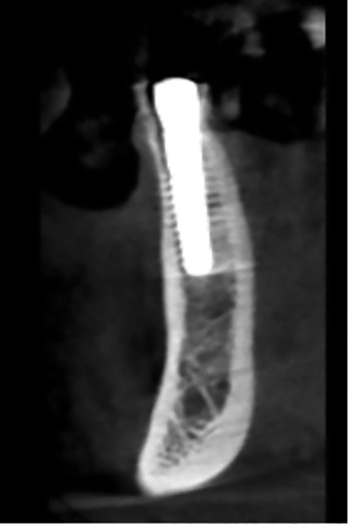 Dental Implant Placement