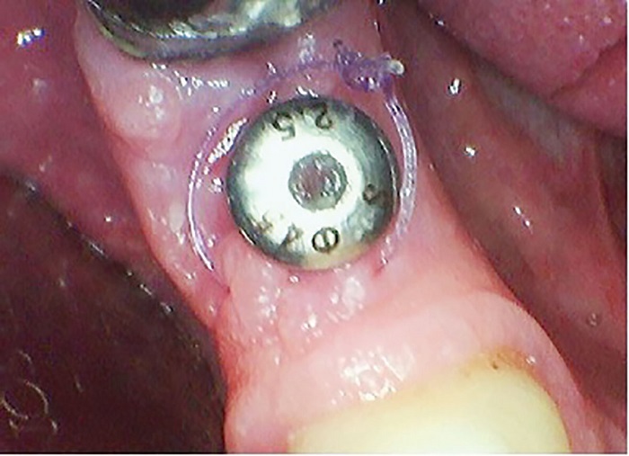 Dental Implant Placement