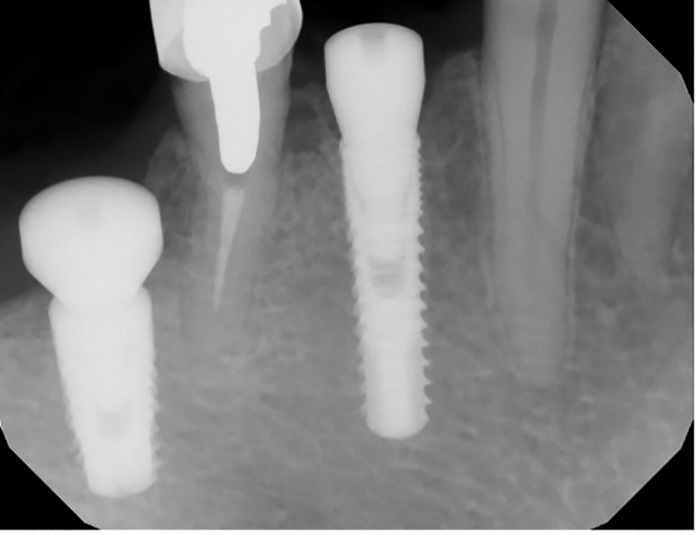 Dental Implant Placement